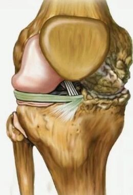 Arthrose des Kniegelenks