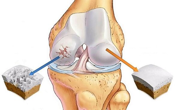 Norm und Abweichung zur Arthrose des Kniegelenks