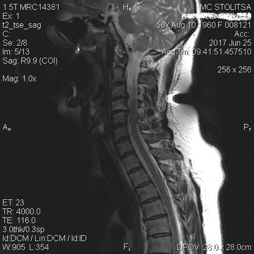 Osteochondrose und Spondylose der Halswirbelsäule