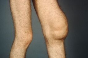 Die Ursachen und Symptome der Arthrose des Kniegelenks