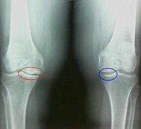 Das Ergebnis der Behandlung von Arthritis- und Arthrosis -Volksmitteln