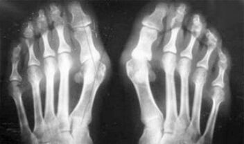 Differentialdiagnose von Symptomen von Arthritis und Arthrose
