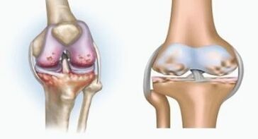 Ursachen von Arthritis und Arthrose