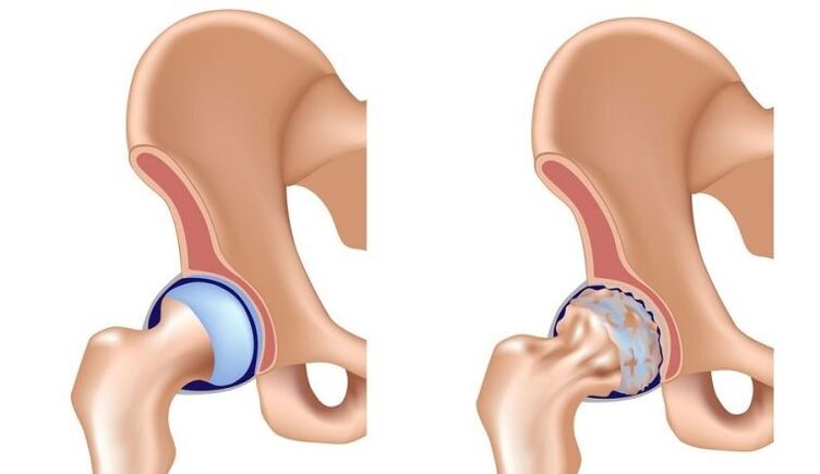 Gesund und gemeinsam mit Arthrose