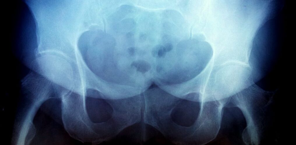 X -RAY -Bild mit Arthrose des 2. Grades